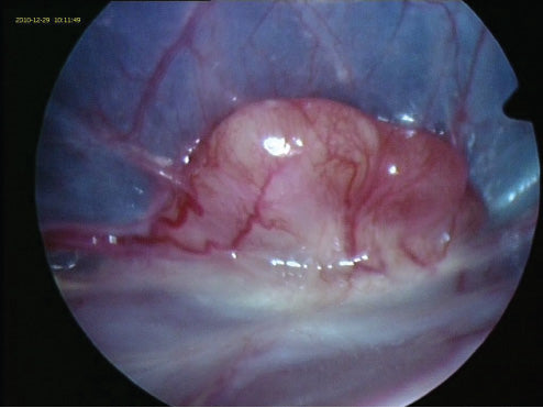 Aspergillosis (Al-Riddad)